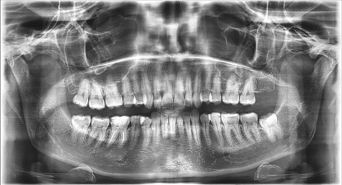 Телерентгенография (трг) зубов