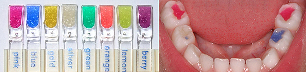 Лечение молочных зубов, цветные пломбы