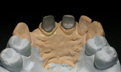 Вкладка на зуб из хромоникелевого сплава