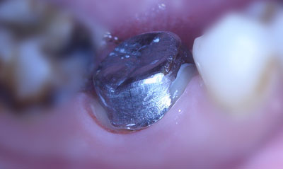 Вкладка на зуб из серебра