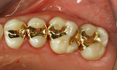Вкладка на зуб из золота с платиной