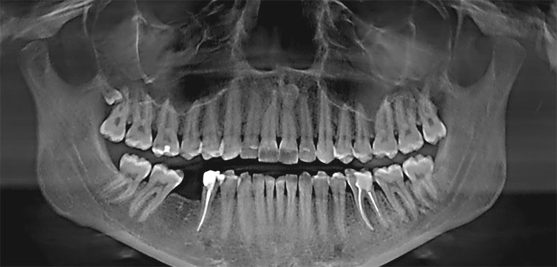 Компьютерная 2D ортопантомография челюсти