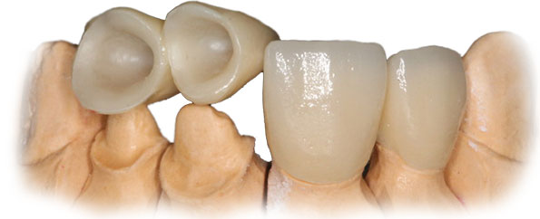 Безметалловые керамические коронки на зубы