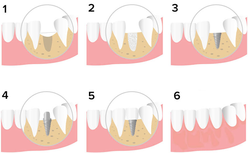 Костная пластика при установке зубного импланта