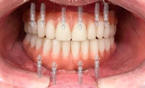 Имплантация зубов при полном отсутствии