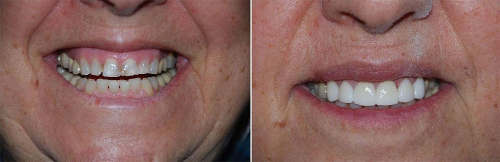 виниры на кривые зубы до и после фото №4