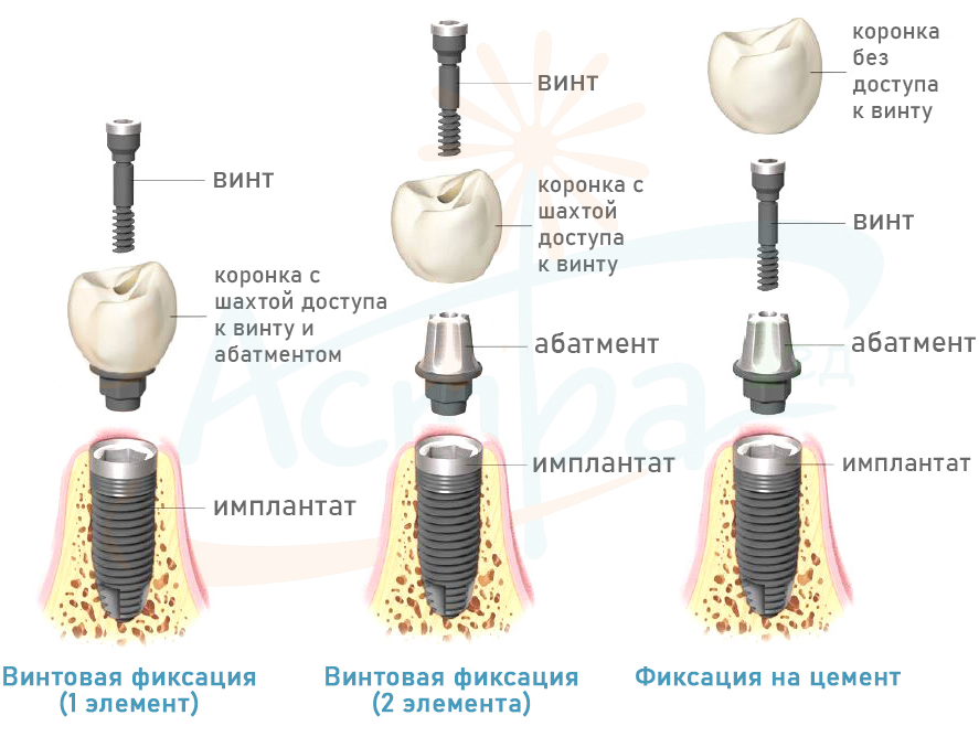 Винтовая фиксация зубного импланта