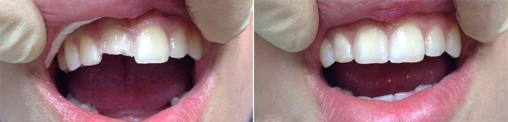 Виниры на зуб после скола, фото до и после №5