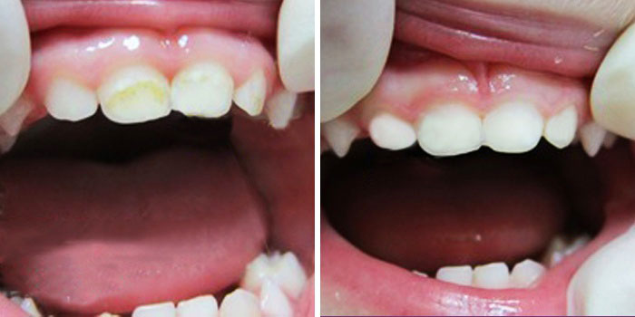 Фторирование молочных зубов. Фото до и после