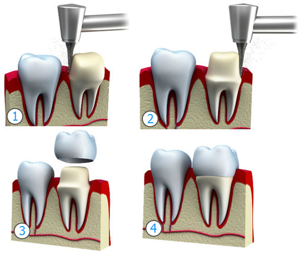 Коронка на зуб в 4 шага