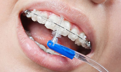 Профессиональная чистка зубов с брекетами