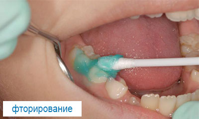 Лечение молочных зубов у детей в Перми
