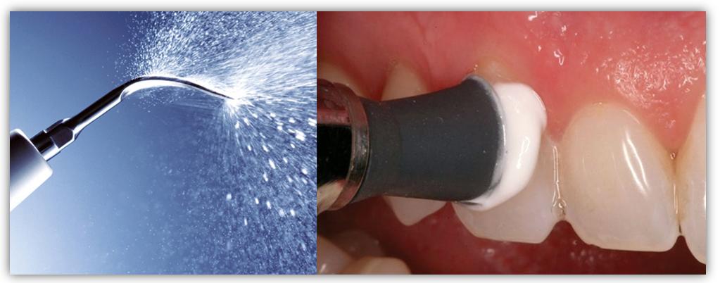Отбеливание зубов и гигиена полости рта