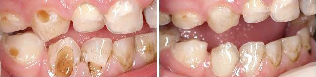 Фторирование зубов. Фото до и после