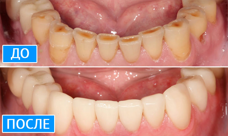 Безметалловые коронки на передние зубы. Фото до и после