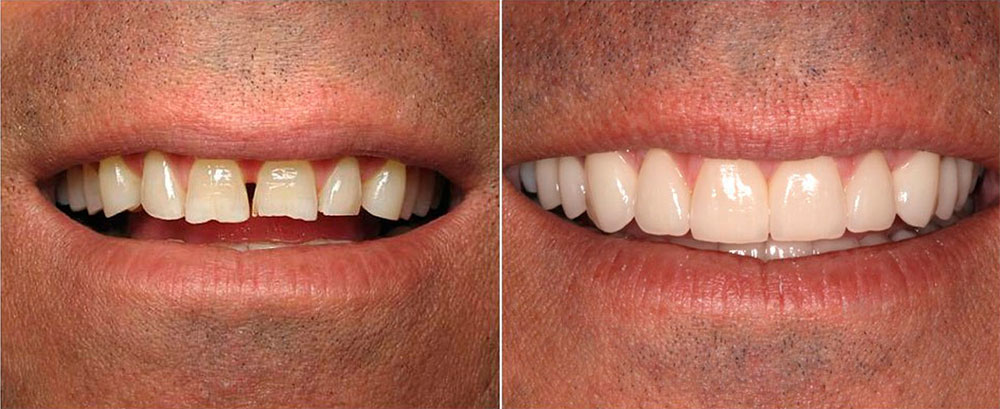 виниры на зубы фото до и после №3