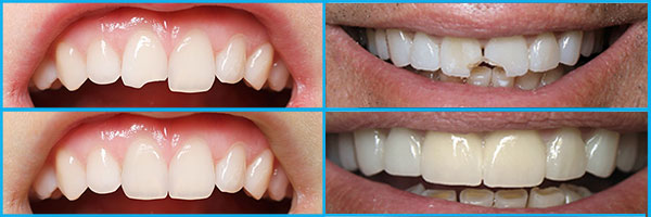 Частичное восстановление зуба