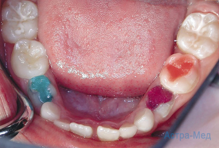 Восстановление молочных больших зубов у детей методом поставки цветной пломбы