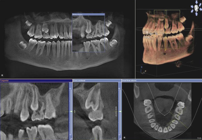 Компьютерная 3D томография челюсти