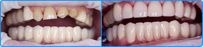 Эстетическая стоматология - реставрация зубов