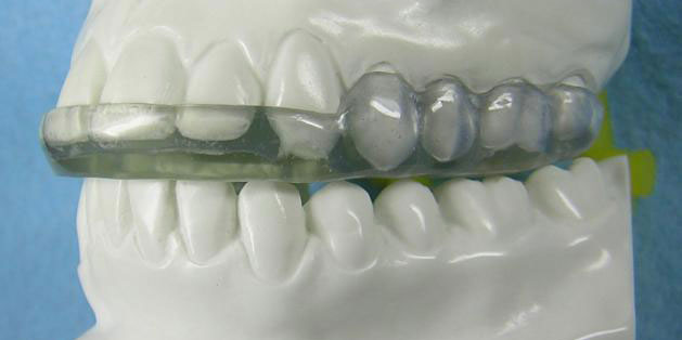 Фото стоматологической капы - образец