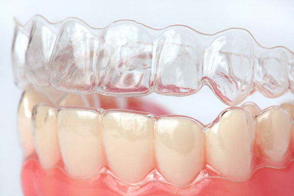 Исправление прикуса зубов элайнерами