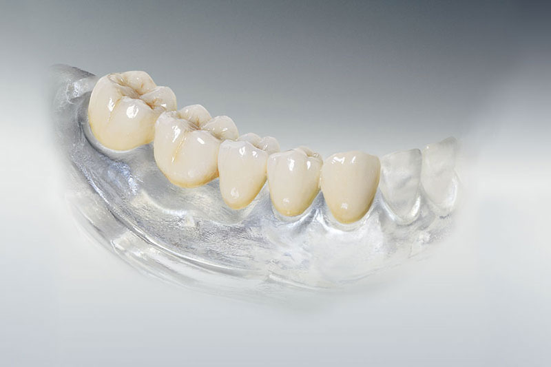 Металлокерамика на зубы в Перми