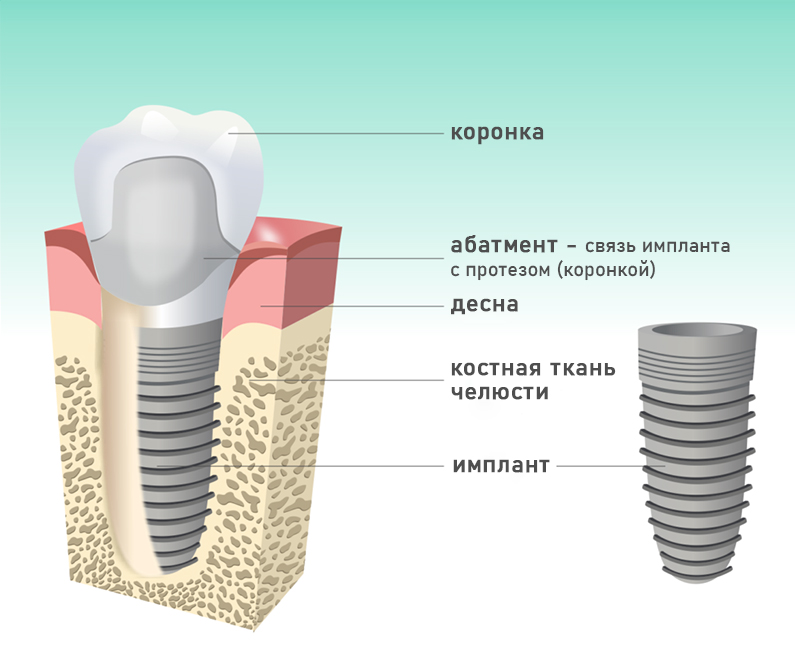 Схема имплантации зуба